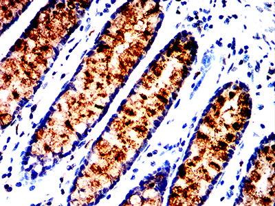 Figure 8:Immunohistochemical analysis of paraffin-embedded rectum cancer tissues using ALPG mouse mAb with DAB staining.