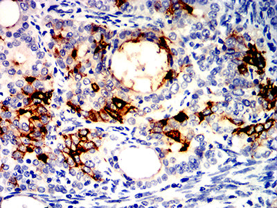 Figure 7:Immunohistochemical analysis of paraffin-embedded cervical cancer tissues using ALPG mouse mAb with DAB staining.